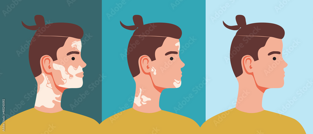 Vitiligo in man, guy isolated, flat vector stock illustration as concept of stage of skin disease disease Vitiligo in man, guy isolated, flat vector stock illustration as concept of stage of skin disease disease