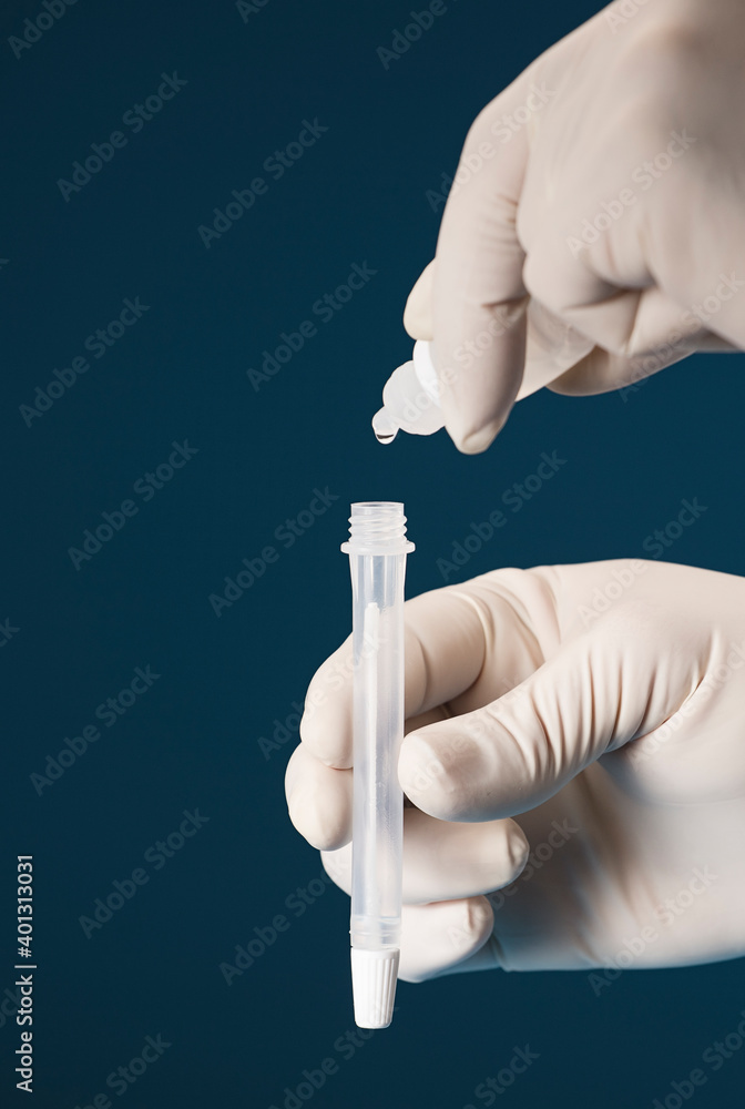 Doctor containing a COVID-19 2019-nCoV viral disease test kit. SARS-CoV-2 coronavirus virus lab card kit test. COVID-19 rapid test. Positive COVID-19. Doctor containing a COVID-19 2019-nCoV viral disease test kit. SARS-CoV-2 coronavirus virus lab card kit test. COVID-19 rapid test. Positive COVID-19.