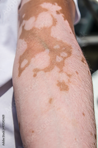 Woman holding hands together on a wooden background. she has skin disorder called vitiligo - white patches caused by loss of pigmentation.