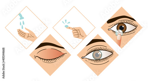 Contact lens infographic. Instruction how to put on lenses. 5 steps wash your hands, take a lens, check the position of the lens. Carefully insert the lens. Design of the brochure