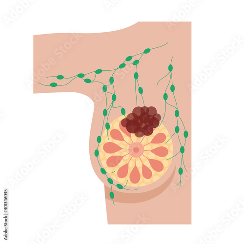 Breast disease concept