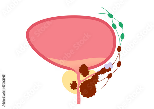 Prostate cancer concept