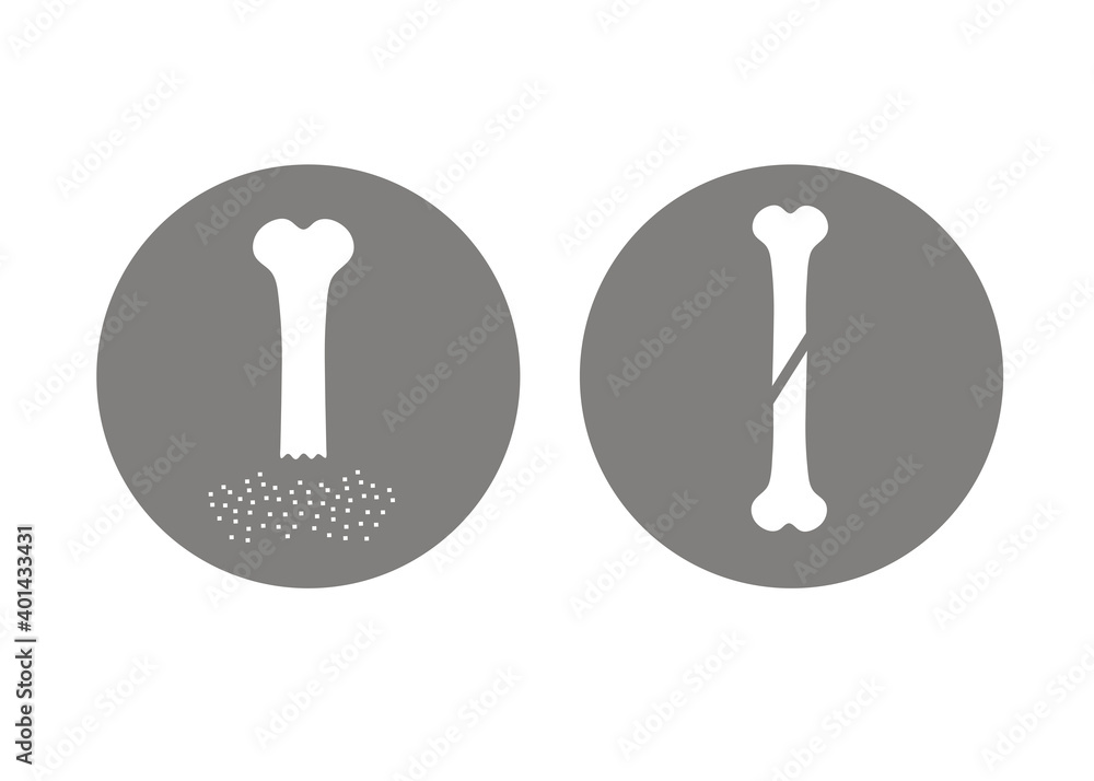 Osteoporosis. Set og two signs. Osteoporosis. Set og two signs.