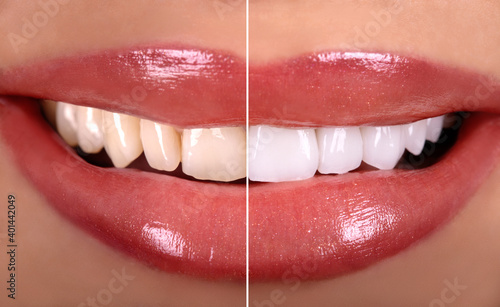Perfect Close Up Before After  Sensual beautiful  woman smile with tongue . White Teeth bleaching ceramic crowns whitening young lady. Dental zircon implants restoration surgery