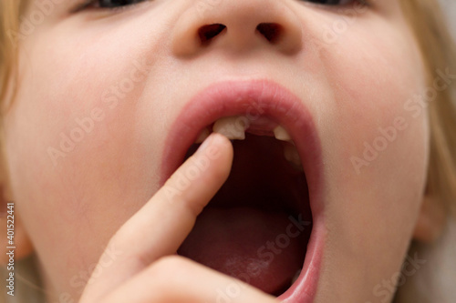 Foto A beautiful little girl of 6-7 years old lost the first milk tooth
