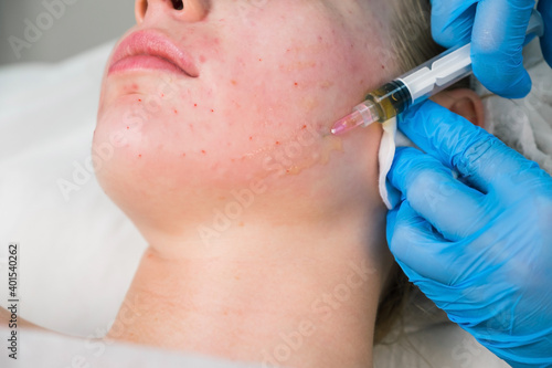 PRP therapy in beauty clinic. Cosmetologist is doing injections of blood plasma to womans face to cure problem skin, closeup view. Treatment of skin in cosmetology for young female.