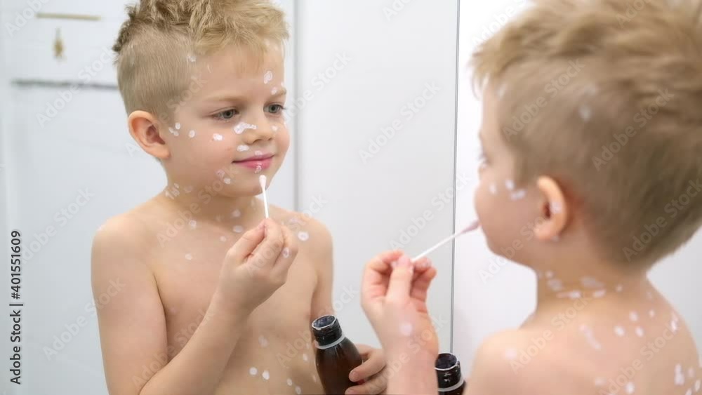Little boy applying white antiseptic cream onto skin. Varicella virus or Chickenpox bubble rash on child Little boy applying white antiseptic cream onto skin. Varicella virus or Chickenpox bubble rash on child