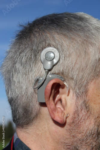 cochlea implant close up, therapy, hearing aid, hearing aid for deaf people to restore hearing, hearing disability trying to hear something photo