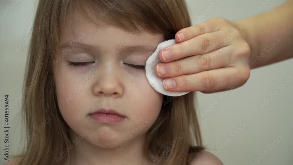 Mothers hands apply sterile cotton ball of antispeptic to eye of little