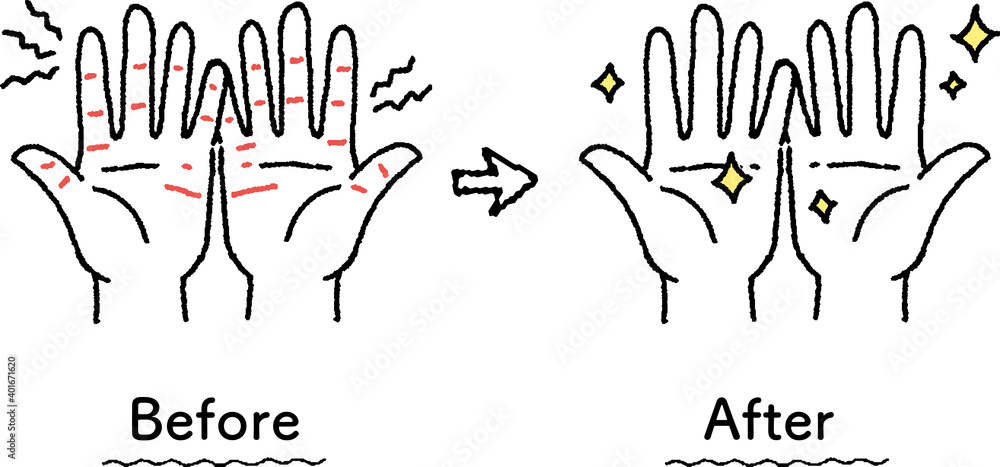 あかぎれがスキンケアで綺麗になった手のイラスト ビフォーアフター Illustration Of A Hand With Chapped Skin That Has Been Cleaned Up With Skin Care Before And After Stock Vector Adobe Stock あかぎれがスキンケアで綺麗になった手のイラスト ビフォーアフター Illustration Of A Hand With Chapped Skin That Has Been Cleaned Up With Skin Care Before And After Stock Vector Adobe Stock