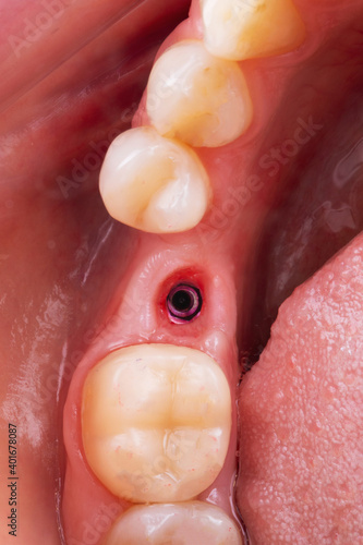 the gum cavity with the installed dental implant