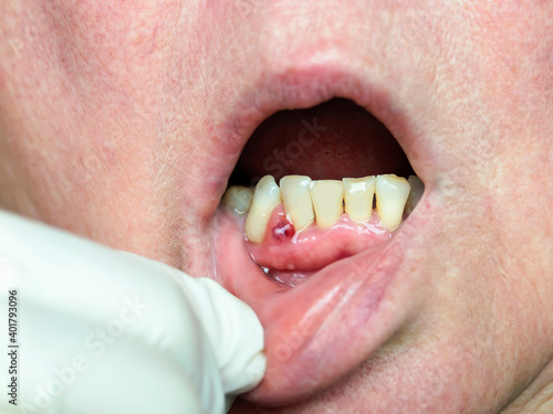 On the gum, an abscess formed, a tumor with purulent contents. Dentist examination.