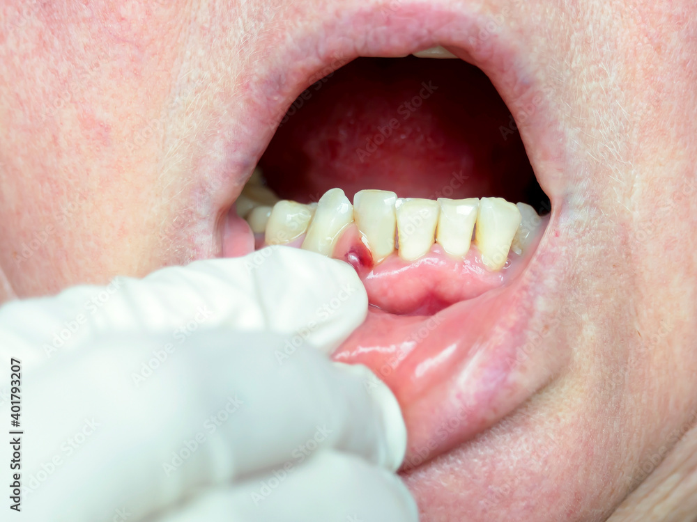 Obraz premium On the gum, an abscess formed, a tumor with purulent contents. Dentist examination.