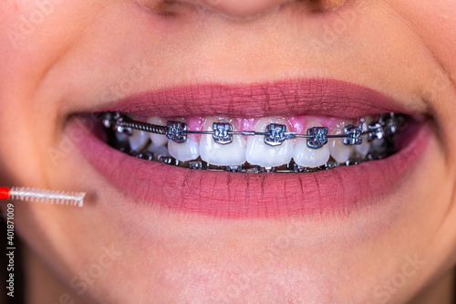 Dentist and orthodontist concept. Girl with braces cleaning teeth using brushes