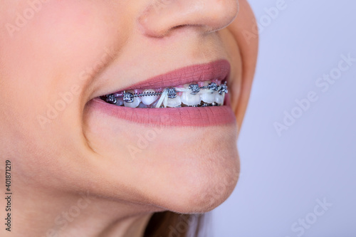Close up portrait of a happy teen girl with braces and beautiful smile on white background