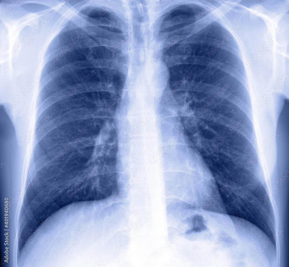 X-Ray Image Of Human Chest X-Ray Image Of Human Chest