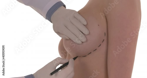 Plastic surgery doctor draw line on patient breast. Breast reduction surgery. Breast implant removal. Isolated on the white background.