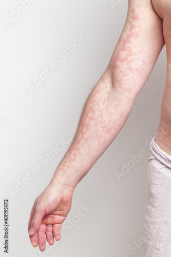 Male arm with red skin capillary network