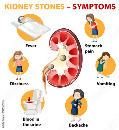 Kidney stones symptoms cartoon style infographic