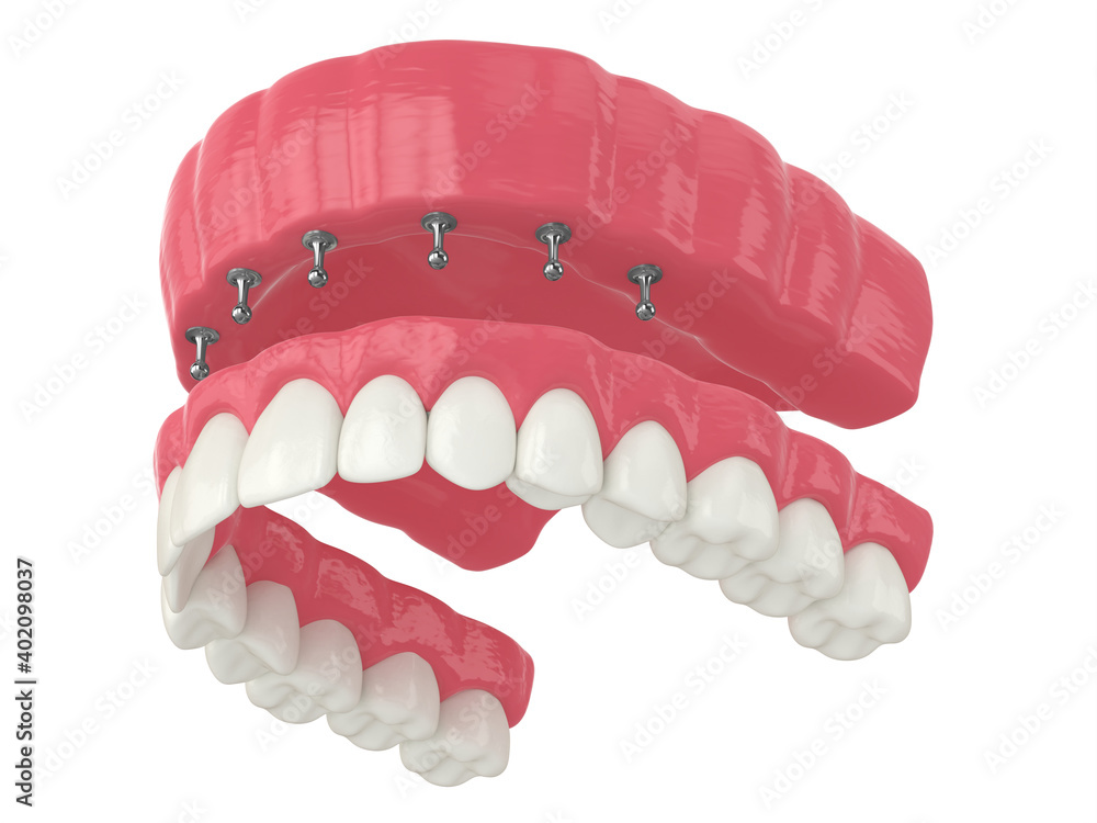 3d render of removable snap-on full implant denture installation 3d render of removable snap-on full implant denture installation