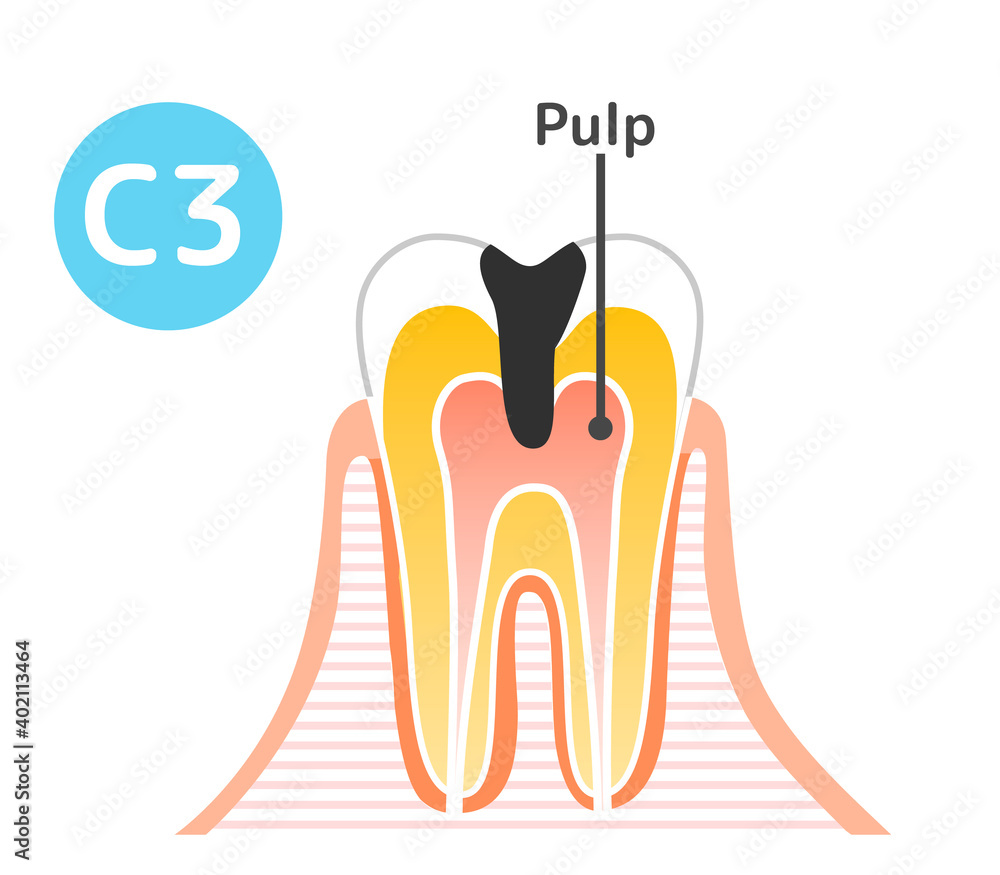 Caries and Progression and Treatment: Dental Illustration Caries and Progression and Treatment: Dental Illustration