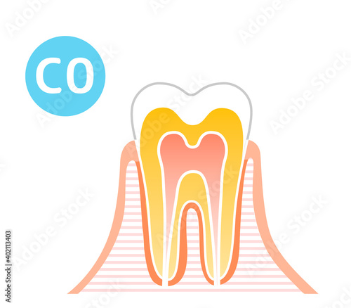 Caries and Progression and Treatment: Dental Illustration