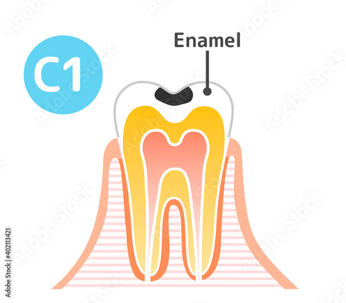 Caries and Progression and Treatment: Dental Illustration
