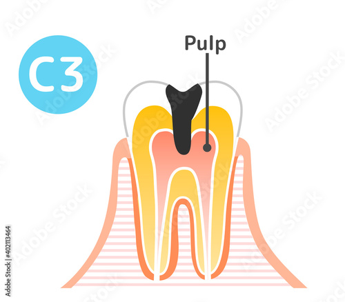 Caries and Progression and Treatment: Dental Illustration