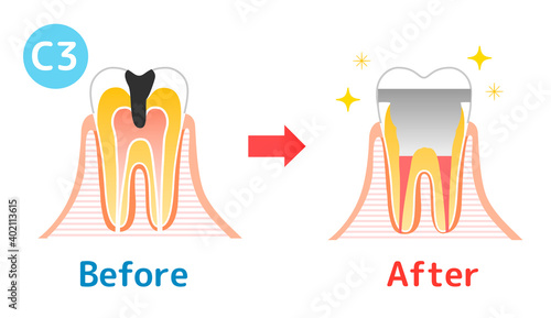 Caries and Progression and Treatment: Dental Illustration