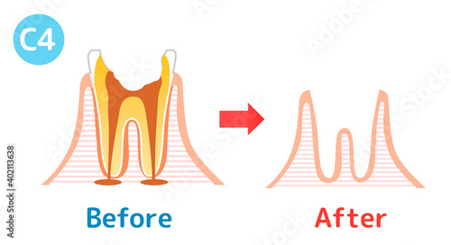 Caries and Progression and Treatment: Dental Illustration