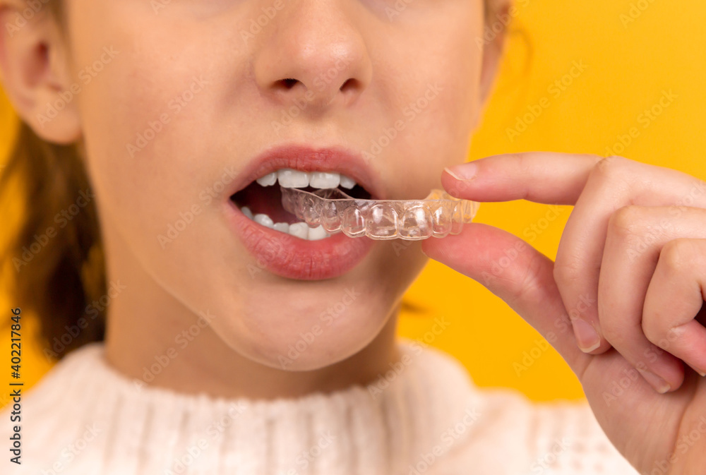 A beautiful girl puts a dental retainer on her teeth, she stands on a yellow background. Orthodontist. Dental tray. Retainer. Advertising. Place for an inscription.