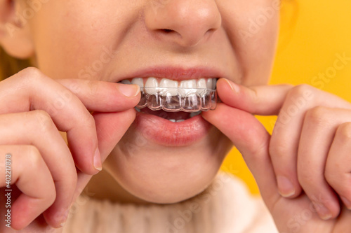 A beautiful girl puts a dental retainer on her teeth, she stands on a yellow background. Orthodontist. Dental tray. Retainer. Advertising. Place for an inscription.