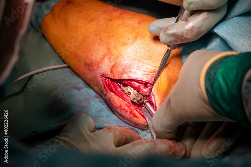 in operation an elbow fracture is treated by doctors with a titanium plate