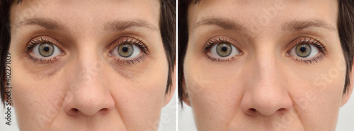Female eye bags before and after cosmetic treatment or plastic procedure, blepharoplasty. Close-up.