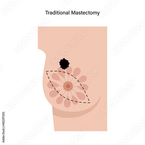 Breast disease concept