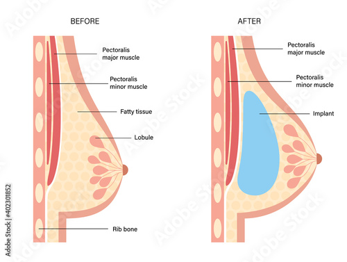 Breast Implant Concept