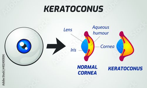 Normal cornea and keratoconus concept. Vector illustration.