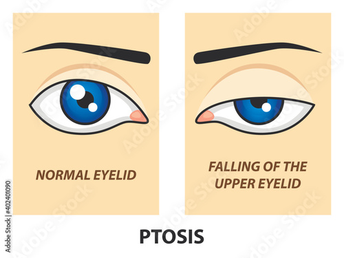 Ptosis. Normal eyelid and falling of the upper eyelid. Vector illustration.