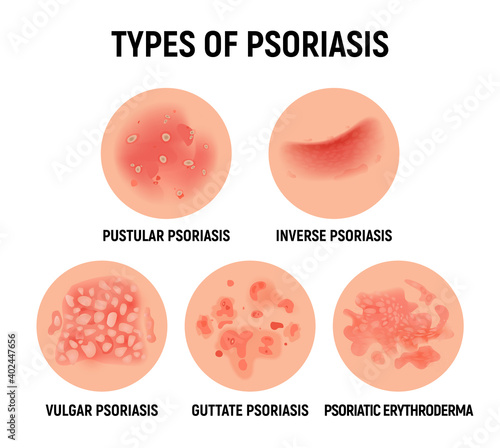 Psoriasis rash vector skin hand infection background. Psoriasis dermatitis eczema cartoon illustration