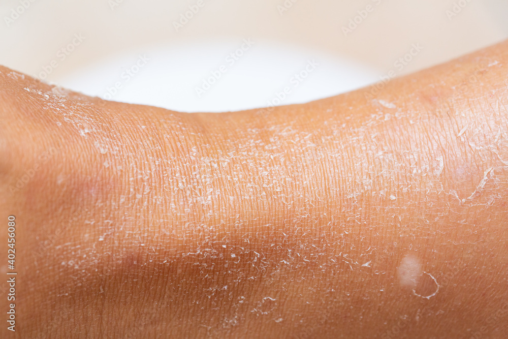 Close up human skin epidermis texture with flaking and cracked particles Close up human skin epidermis texture with flaking and cracked particles