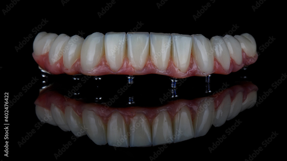 ceramic dental prosthesis made of ceramic with pink gums of the lower jaw on a black background ceramic dental prosthesis made of ceramic with pink gums of the lower jaw on a black background