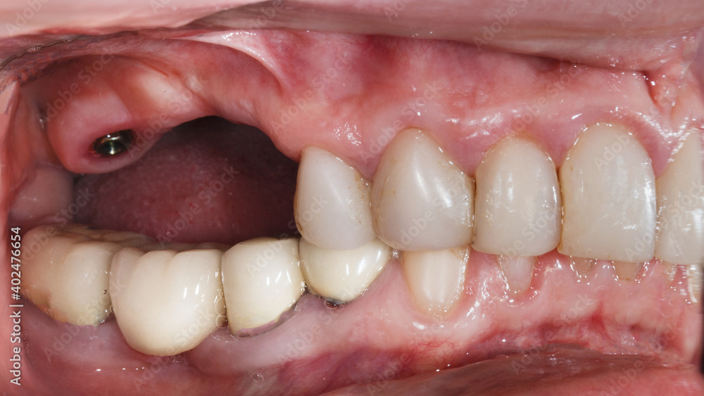 Obraz premium jaw after implantation before prosthetics of a ceramic or zircon bridge on the chewing teeth