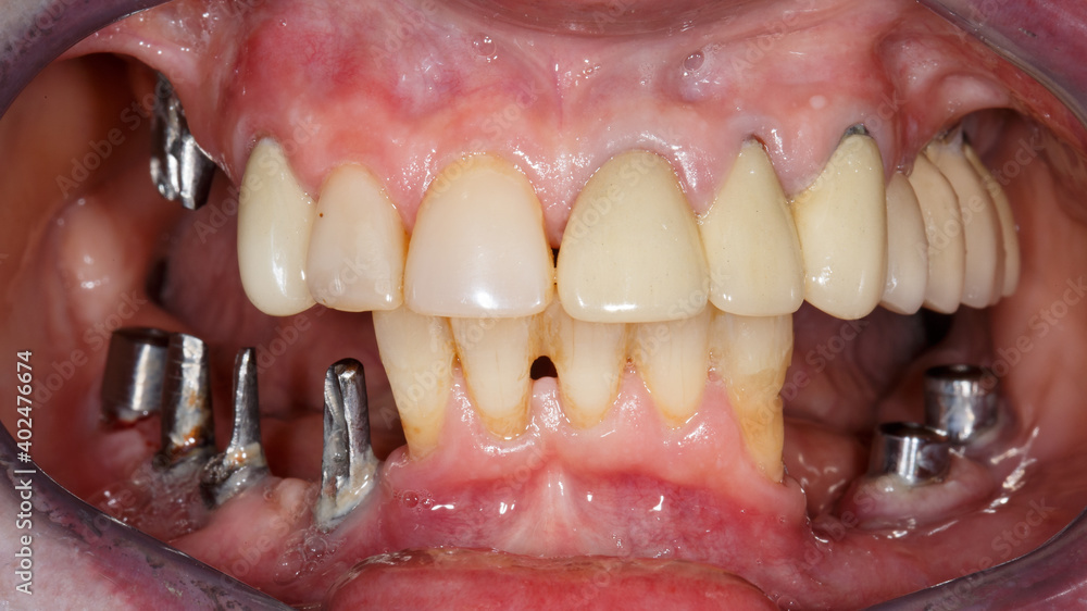 problems with implants and removed dental crowns in the patient's mouth