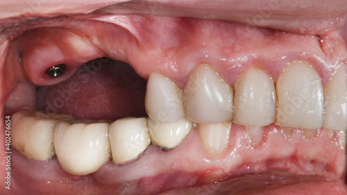 jaw after implantation before prosthetics of a ceramic or zircon bridge on the chewing teeth