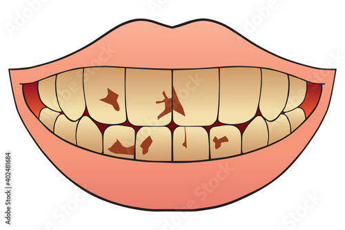 Nicotine Stained Teeth