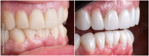 before and after picture after fixing 20 unit emax press ceramic veneers