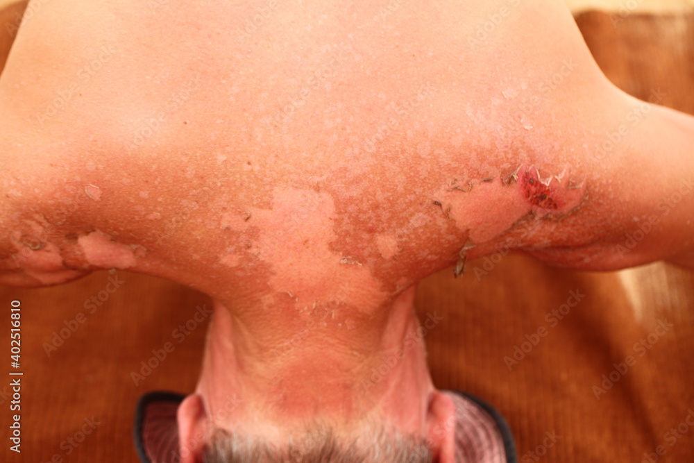Fototapeta premium sunburn skin on the back of a man