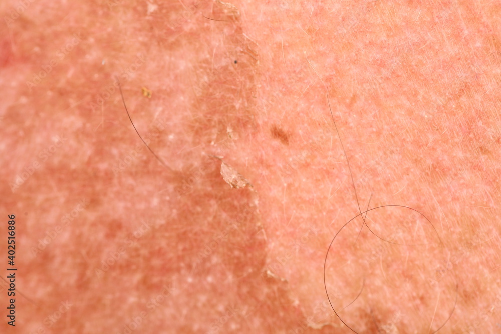 Fototapeta premium sunburn skin on the back of a man