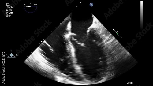 Transesophageal ultrasound video in gray-scale mode.
