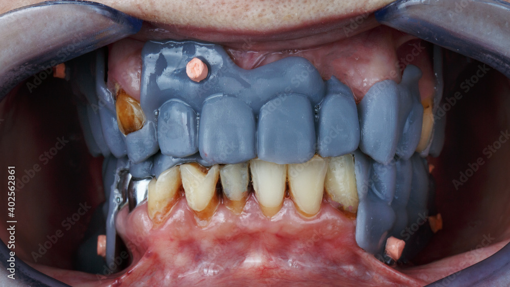Obraz premium wax up digital future dental prosthesis and bridges, after implantation